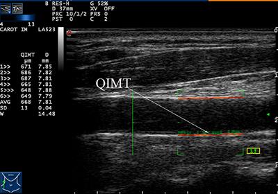 Association of Adipocytokines With Carotid Intima Media Thickness and Arterial Stiffness in Obstructive Sleep Apnea Patients